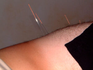 Healing with acupuncture
